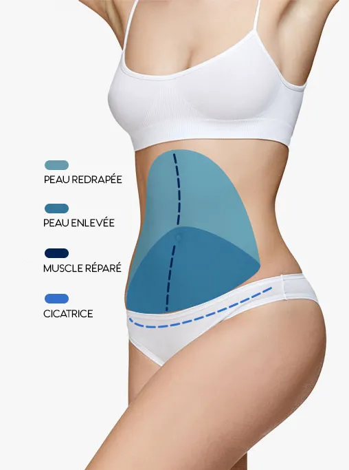 Abdominoplastie standard