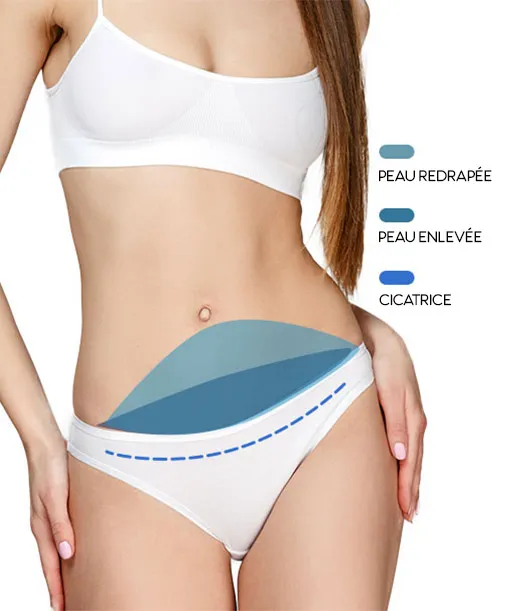 Mini-abdominoplasty Tunisia