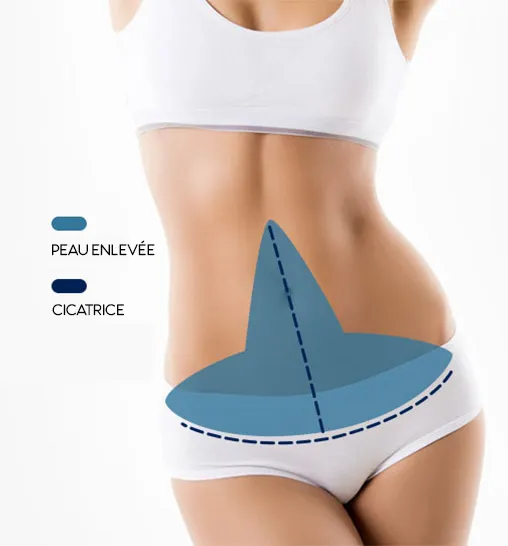 Abdominoplastie inversée