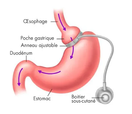 Gastric band Tunisia