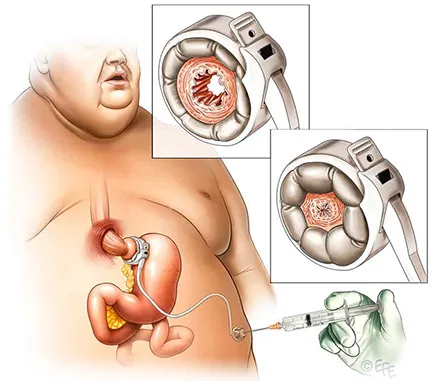 Gastric band Tunisia