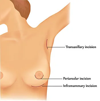 Incision et emplacement prothèse mammaire