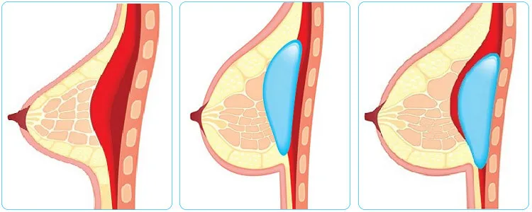 Location of breast implants