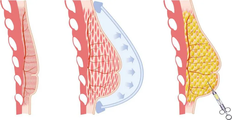 Fat injection to breasts