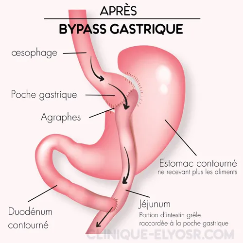 After gastric Bypass Tunisia