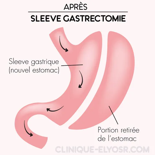 After gastric sleeve Tunisia