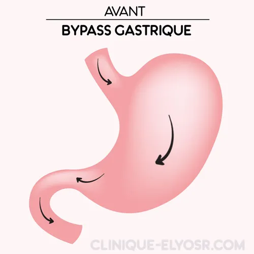 Before gastric Bypass Tunisia