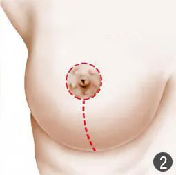 Breast reduction Tunisia